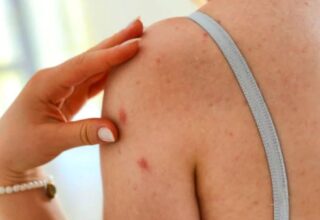 Esra Dermancıoğlu zona hastalığına yakalandığını duyurdu (Zona nedir, belirtileri neler?)